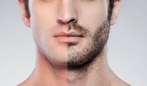 transplante de barba